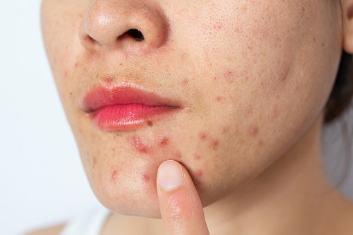 Acne-Prone Skin? Go For Lightweight Oils
