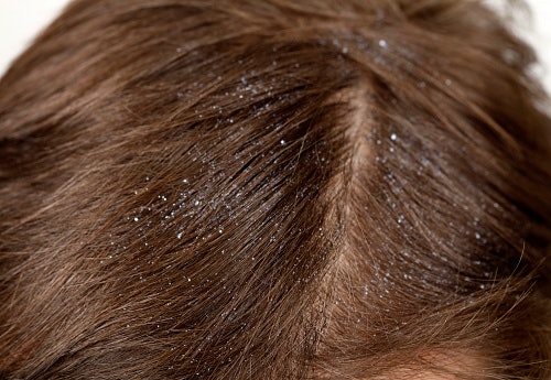 Give Special Attention to Dandruff-Prone Hair
