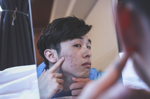 People With Sensitive Skin Should Avoid Chemical and Alcohol-Based Creams Or Oils Like Tea Tree, Mint